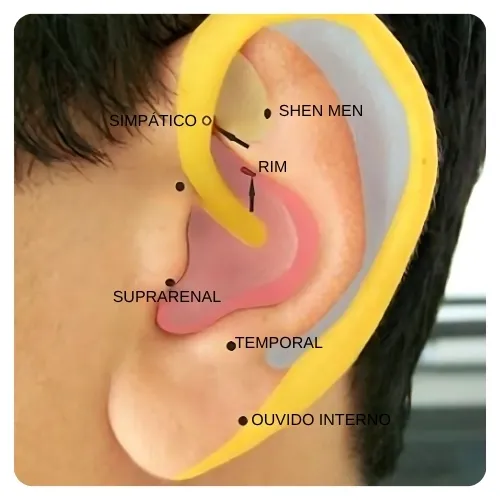 Auriculoterapia para zumbido